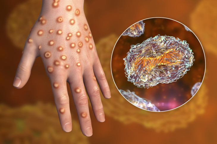 A 3D-s illusztráció egy Mpox-ban szenvedő beteget mutat