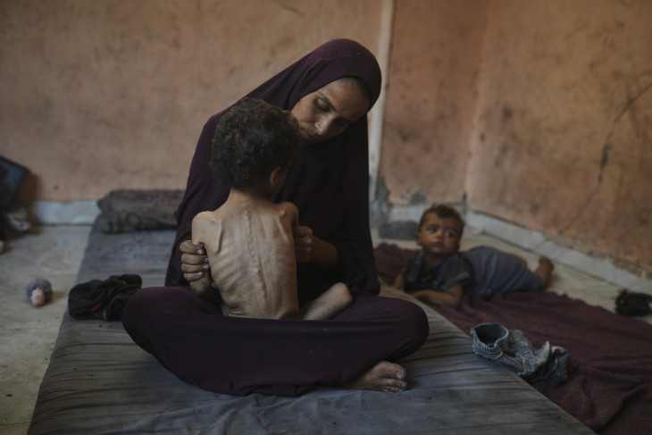Naima Abu Ful palesztin anya alultáplált kétéves kisfia, Jazan hátát mutatja a Sati belföldi menekülttáborban levő otthonukban, Gáza városában 2025. július 23-án