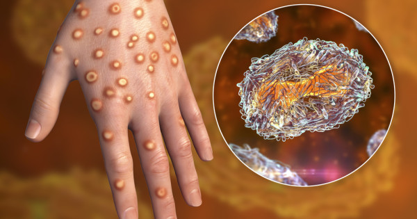 Una nueva cepa mortal de viruela simica podría convertirse en una pandemia mundial Una nueva cepa mortal de viruela simica podría convertirse en una pandemia mundial